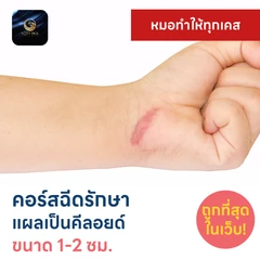 คอร์สฉีดรักษาแผลเป็นคีลอยด์ ขนาดเส้นผ่านศูนย์กลาง 1-2 ซม. 1 จุด 5 ครั้ง