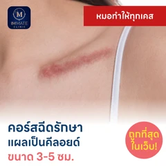 คอร์สฉีดรักษาแผลเป็นคีลอยด์ ขนาดเส้นผ่านศูนย์กลาง 3-5 ซม. 1 จุด 5 ครั้ง