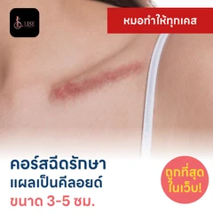 คอร์สฉีดรักษาแผลเป็นคีลอยด์ ขนาดเส้นผ่านศูนย์กลาง 3-5 ซม. 1 จุด 5 ครั้ง
