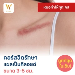 คอร์สฉีดรักษาแผลเป็นคีลอยด์ ขนาดเส้นผ่านศูนย์กลาง 3-5 ซม. 1 จุด 5 ครั้ง