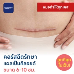 คอร์สฉีดรักษาแผลเป็นคีลอยด์ ขนาดเส้นผ่านศูนย์กลาง 6-10 ซม. 1 จุด 5 ครั้ง