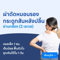 ผ่าตัดหมอนรองกระดูกสันหลังปลิ้นผ่านกล้องเอ็นโดสโคป (2 เลเวล)