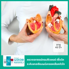 ตรวจเอกซเรย์คอมพิวเตอร์ เพื่อวัดระดับแคลเซียมผนังหลอดเลือดหัวใจ (CT Calcium Score) สำหรับผู้ที่อายุ 45 ปีขึ้นไป