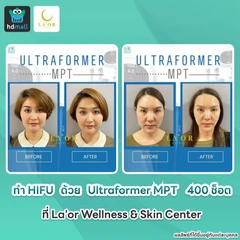 ทำ HIFU ด้วยเครื่อง Ultraformer MPT 400 ช็อต ยกกระชับบริเวณทั่วใบหน้าและเหนียง 1 ครั้ง