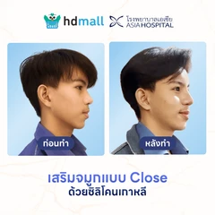 เสริมจมูกด้วยซิลิโคนเกาหลี เทคนิคแบบ Close สำหรับเคสเสริมครั้งแรก ที่ โรงพยาบาลเอเซีย