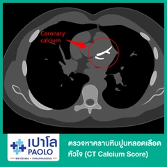 ตรวจหาคราบหินปูนหลอดเลือดหัวใจ (CT Calcium Score)