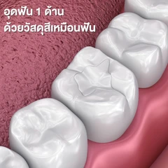 อุดฟัน 1 ด้าน ด้วยวัสดุสีเหมือนฟัน
