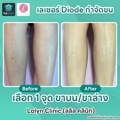 เลเซอร์ Diode กำจัดขน (เลือก 1 จุด ขาบน/ขาล่าง)