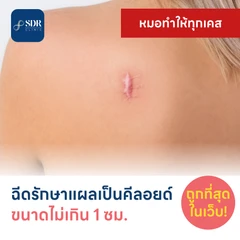 ฉีดรักษาแผลเป็นคีลอยด์ ขนาดเส้นผ่านศูนย์กลางไม่เกิน 1 ซม. 1 จุด 1 ครั้ง