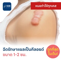 ฉีดรักษาแผลเป็นคีลอยด์ ขนาดเส้นผ่านศูนย์กลาง 1-2 ซม. 1 จุด 1 ครั้ง