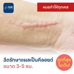 ฉีดรักษาแผลเป็นคีลอยด์ ขนาดเส้นผ่านศูนย์กลาง 3-5 ซม. 1 จุด 1 ครั้ง