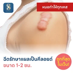 ฉีดรักษาแผลเป็นคีลอยด์ ขนาดเส้นผ่านศูนย์กลาง 1-2 ซม. 1 จุด 1 ครั้ง