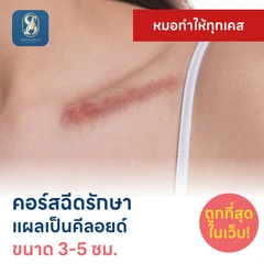 คอร์สฉีดรักษาแผลเป็นคีลอยด์ ขนาดเส้นผ่านศูนย์กลาง 3-5 ซม. 1 จุด 5 ครั้ง