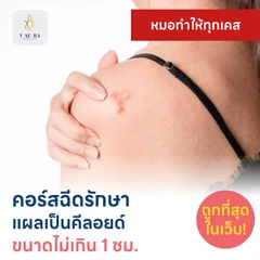คอร์สฉีดรักษาแผลเป็นคีลอยด์ ขนาดเส้นผ่านศูนย์กลางไม่เกิน 1 ซม. 1 จุด 5 ครั้ง