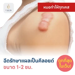 ฉีดรักษาแผลเป็นคีลอยด์ ขนาดเส้นผ่านศูนย์กลาง 1-2 ซม. 1 จุด 1 ครั้ง