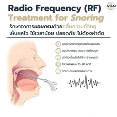 รักษานอนกรน ด้วยคลื่นวิทยุ RF