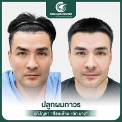ปลูกผมเทคนิค iFUE แบบโกนผม สูงสุด 1,000 กราฟต์