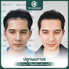 ปลูกผมเทคนิค iDHI แบบโกนผม สูงสุด 1,000 กราฟต์