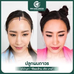 ปลูกผมเทคนิค Non Shaven แบบไม่โกนผม สูงสุด 1,000 กราฟต์