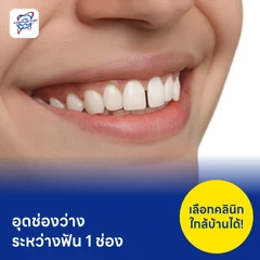 อุดช่องว่างระหว่างฟัน 1 ช่อง