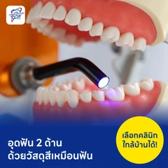 อุดฟัน 2 ด้าน ด้วยวัสดุสีเหมือนฟัน