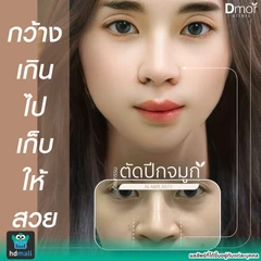 ตัดปีกจมูก เทคนิคซ่อนแผลและเทคนิคแผลนอก (ครั้งแรก)