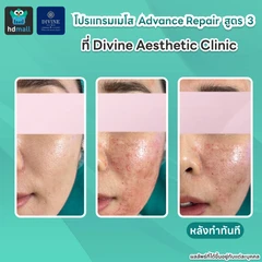 โปรแกรมเมโส Advance Repair สูตร 3 ปริมาณ 5 ซีซี เพื่อปรับผิวหน้าให้ดูเปล่งปลั่ง เรียบเนียน ด้วยเครื่อง Hycoox พร้อม MicroBo USA 10 ยูนิต เพื่อผิวดูเงางาม รูขุมขนดูกระชับ 1 ครั้ง