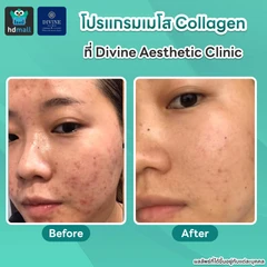 โปรแกรมเมโส Collagen ปรับผิวหน้ากระจ่างใส แก้ปัญหาผื่น สิวเรื้อรัง กระตุ้นคอลลาเจน 4 ซีซี 16 จุด ทั่วใบหน้า 1 ครั้ง