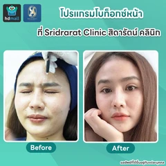 โปรแกรมโบท็อกซ์ 100 ยูนิต (หน้า) 1 ครั้ง ฟรี! โปรแกรมเมโสหน้า จำนวนซีซีขึ้นอยู่กับแพทย์ประเมิน 2 ครั้ง