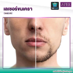 เลเซอร์ Dynamic Tech กำจัดขนเครา 1 ครั้ง (ราคาทดลอง)