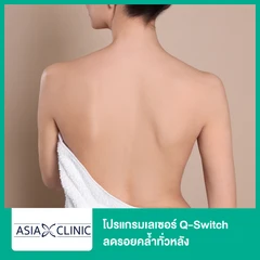 โปรแกรมเลเซอร์ Q-Switch ลดรอยคล้ำทั่วหลัง