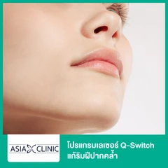 โปรแกรมเลเซอร์ Q-Switch แก้ริมฝีปากคล้ำ