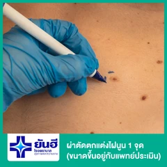 ผ่าตัดตกแต่งไฝนูน 1 จุด (ขนาดขึ้นอยู่กับแพทย์ประเมิน)