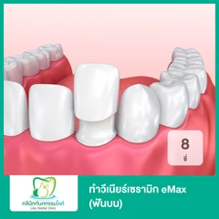 ทำวีเนียร์เซรามิก eMax 8 ซี่ (ฟันบน)
