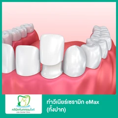 ทำวีเนียร์เซรามิก eMax (ทั้งปาก)