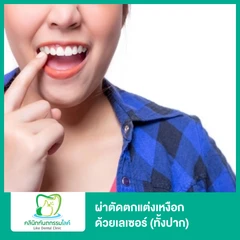 ผ่าตัดตกแต่งเหงือก ด้วยเลเซอร์ (ทั้งปาก)