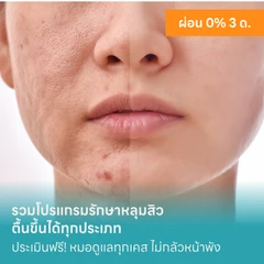 HDmall แนะนำ : รวมโปรแกรมรักษาหลุมสิวด้วย Microneedling / Subcision / Fractional Laser