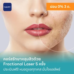คอร์สรักษาหลุมสิวด้วย Fractional Laser 5 ครั้ง