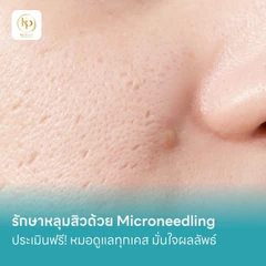 รักษาหลุมสิวด้วย Microneedling 1 บริเวณ 1 ครั้ง