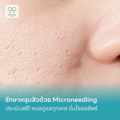 รักษาหลุมสิวด้วย Microneedling