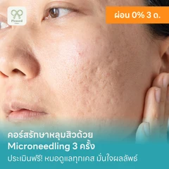 คอร์สรักษาหลุมสิวด้วย Microneedling 3 ครั้ง