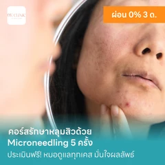 คอร์สรักษาหลุมสิวด้วย Microneedling 5 ครั้ง