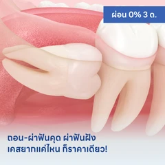 HDmall แนะนำ : ถอน-ผ่าฟันคุด ผ่าฟันฝัง เคสยากแค่ไหน ก็ราคาเดียว!