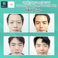 ปลูกคิ้ว เทคนิค Long Hair FUE จำนวนกราฟต์ขึ้นอยู่กับแพทย์ประเมิน (เคสรีวิว)