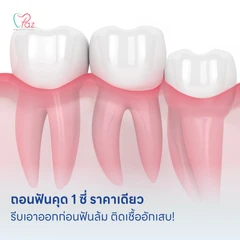 ถอนฟันคุด 1 ซี่ ราคาเดียว