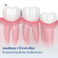 ถอนฟันคุด 1 ซี่ ราคาเดียว