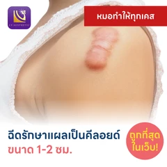 ฉีดรักษาแผลเป็นคีลอยด์ ขนาดเส้นผ่านศูนย์กลาง 1-2 ซม. 1 จุด 1 ครั้ง