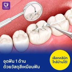 อุดฟัน 1 ด้าน ด้วยวัสดุสีเหมือนฟัน