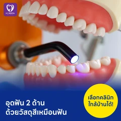 อุดฟัน 2 ด้าน ด้วยวัสดุสีเหมือนฟัน