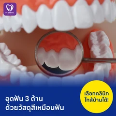 อุดฟัน 3 ด้าน ด้วยวัสดุสีเหมือนฟัน
